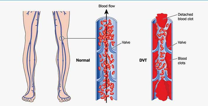 deep vein thrombosis