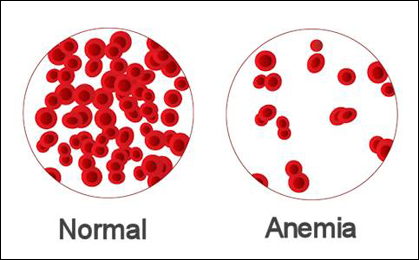 iron deficiency anaemia