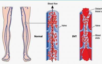 Guard Against Deep Vein Thrombosis With Nattokinase NSK-SD®
