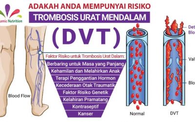 Adakah Anda Mempunyai Risiko Trombosis Urat Mendalam?