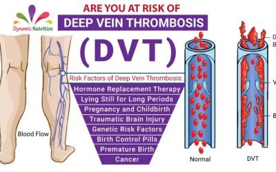Are you at Risk of Deep Vein Thrombosis (DVT)?