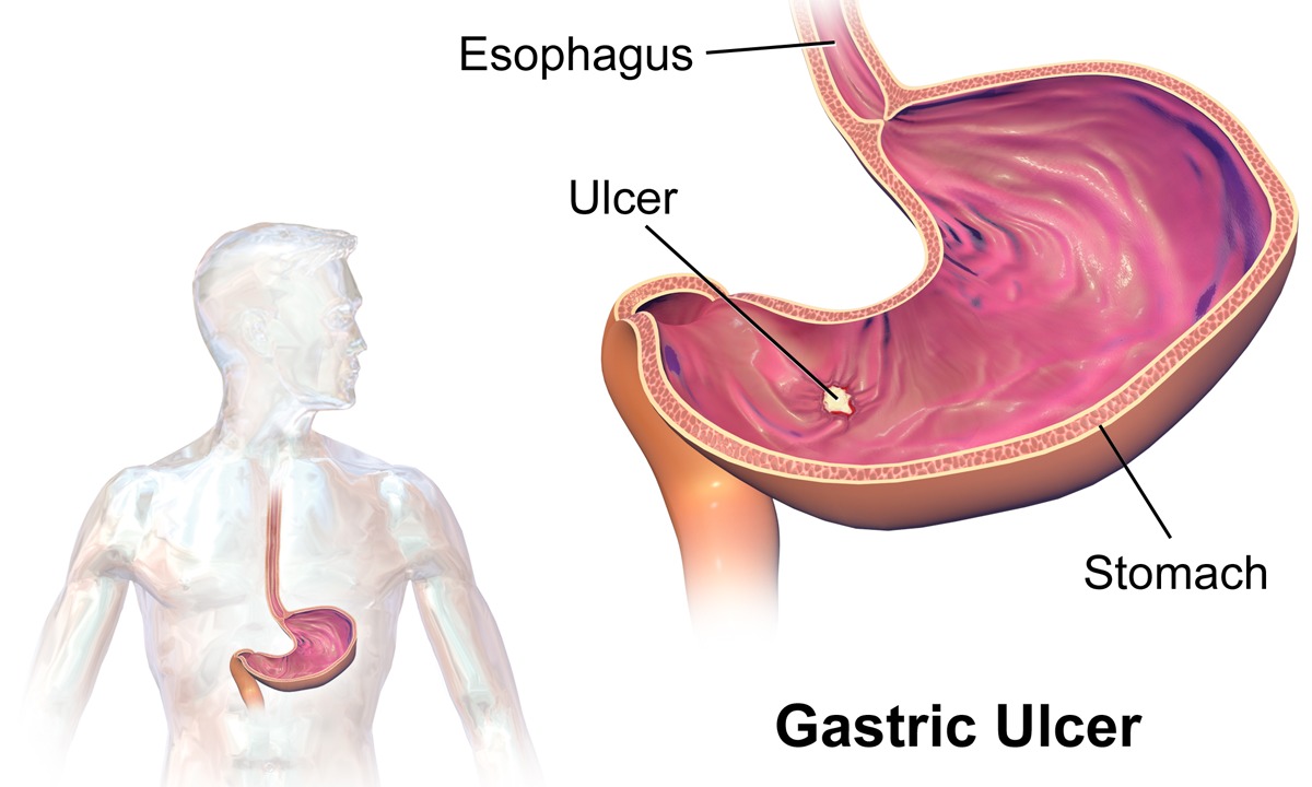 gastric ulcer