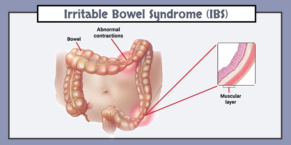 what are symptoms of ibs flare up