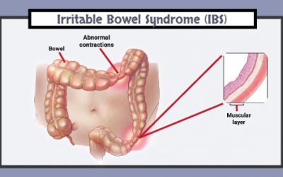 What is Irritable Bowel Syndrome (IBS)?