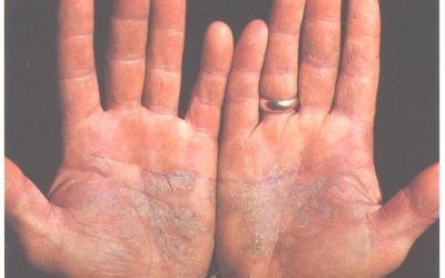 Penyakit Psoriasis: Simptom, Punca, dan Rawatan