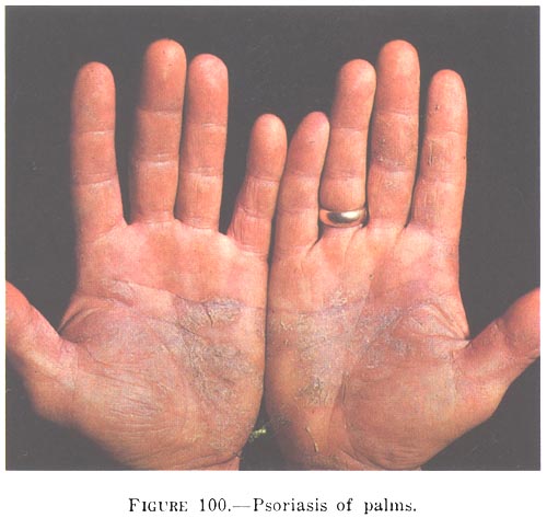 psoriasis on the palms