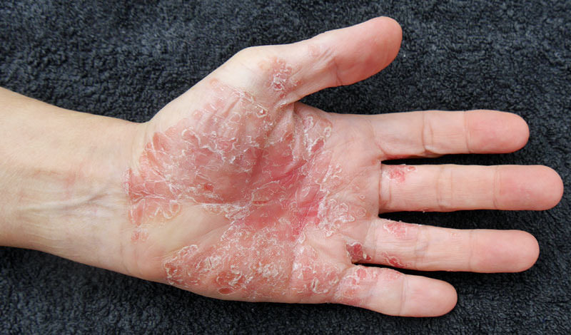 psoriasis on the hand