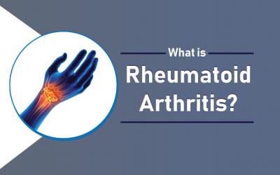 How Rheumatoid Arthritis Affects Your Joints