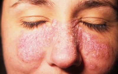 Systemic Lupus Erythematosus (SLE): Signs And Symptoms