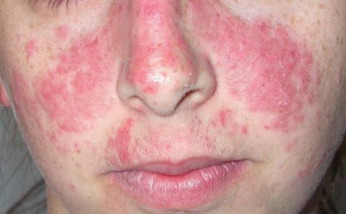 lupus butterfly rash