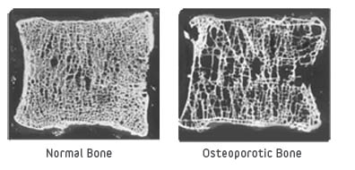 osteoporosis