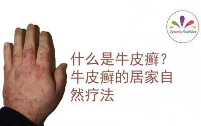 什么是牛皮癣？牛皮癣的居家自然疗法