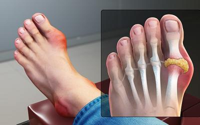 Top 7 Natural Ways To Reduce Uric Acid & Gout