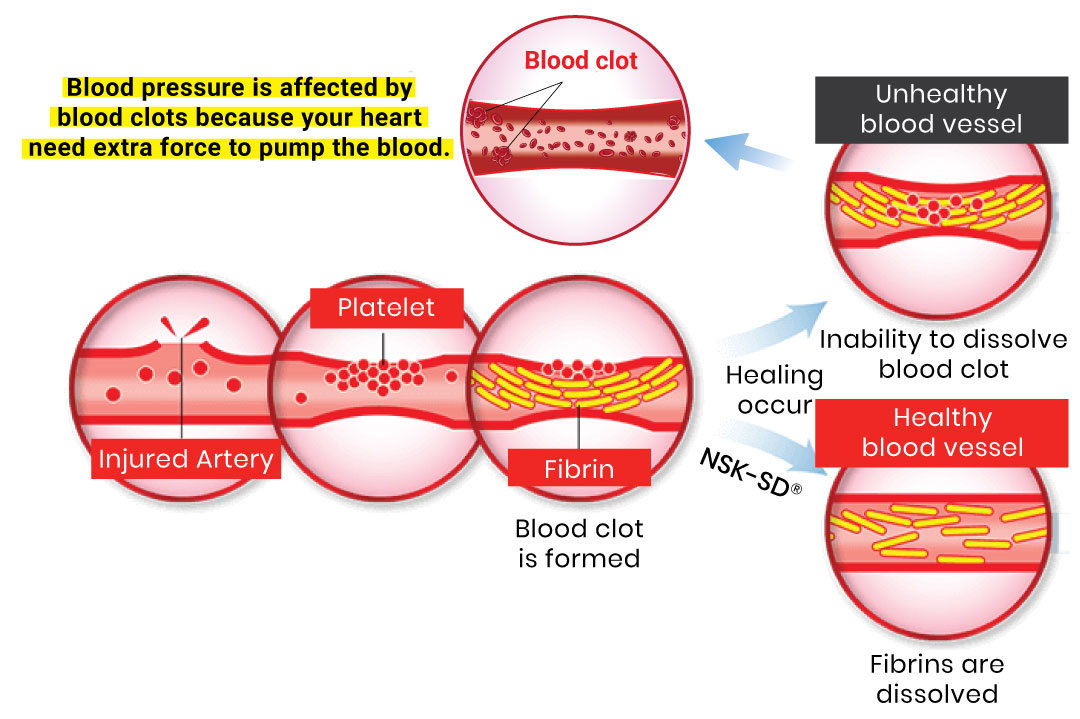 blood clots