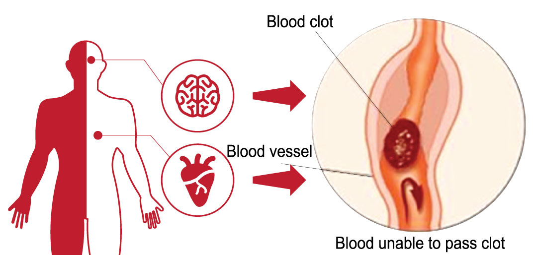 blood clots