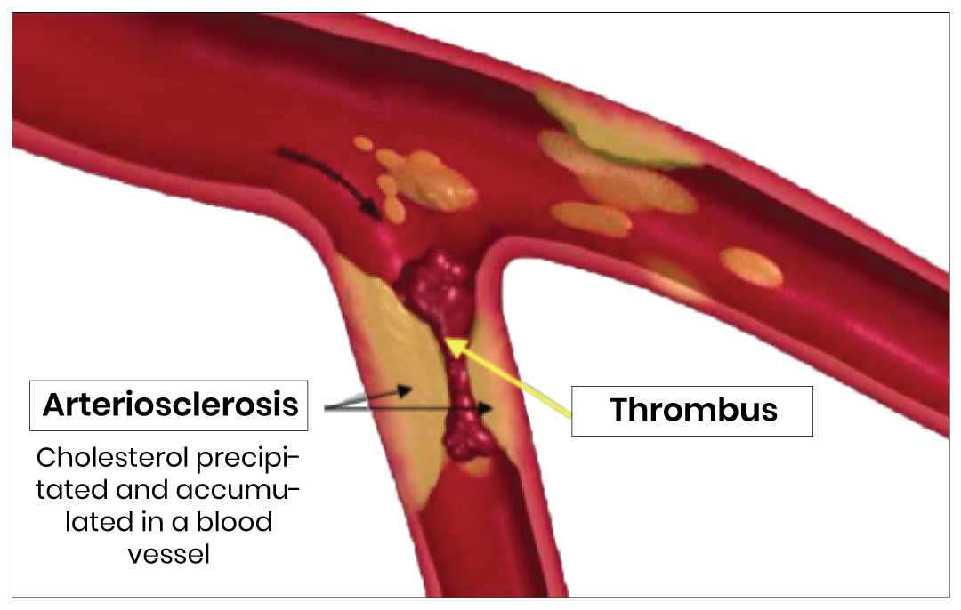 arteriosclerosis